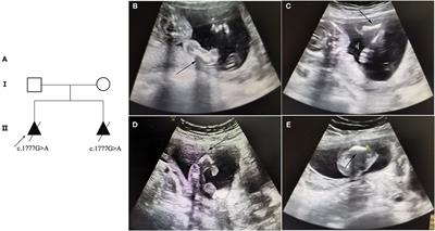 Identification of a Rare Variant of c.1777G>A (p.G593S) in the COL1A1 Gene as the Etiology of Recurrent Osteogenesis Imperfecta by Whole-Exome Sequencing